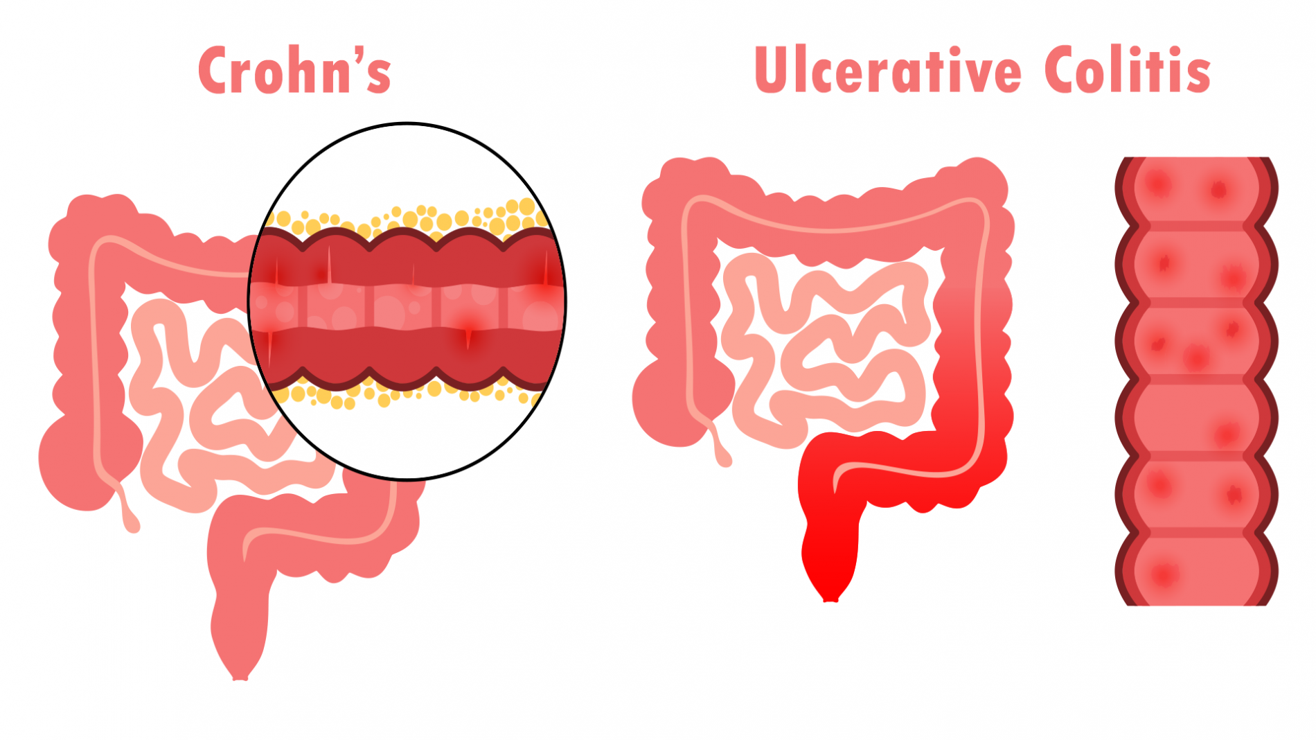 Gut health and ulcerative colitis